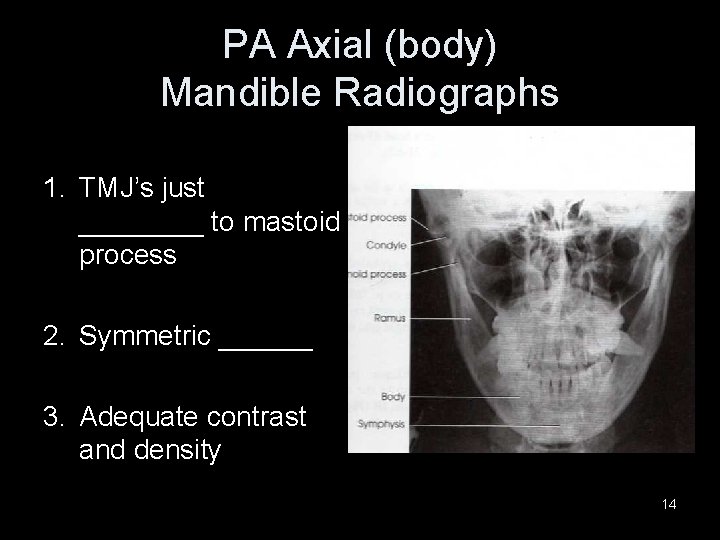 PA Axial (body) Mandible Radiographs 1. TMJ’s just ____ to mastoid process 2. Symmetric