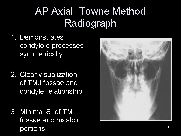 AP Axial- Towne Method Radiograph 1. Demonstrates condyloid processes symmetrically 2. Clear visualization of