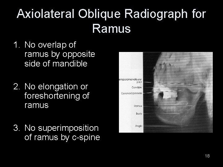 Axiolateral Oblique Radiograph for Ramus 1. No overlap of ramus by opposite side of