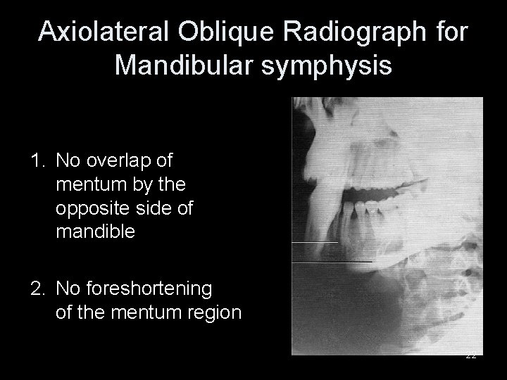 Axiolateral Oblique Radiograph for Mandibular symphysis 1. No overlap of mentum by the opposite