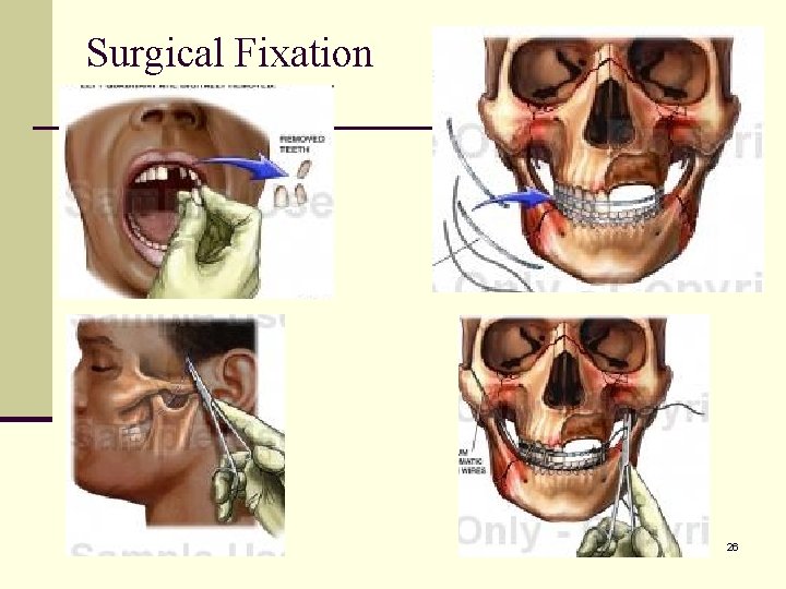 Surgical Fixation 26 