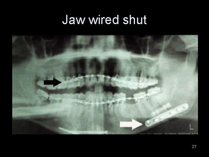 Jaw wired shut 27 