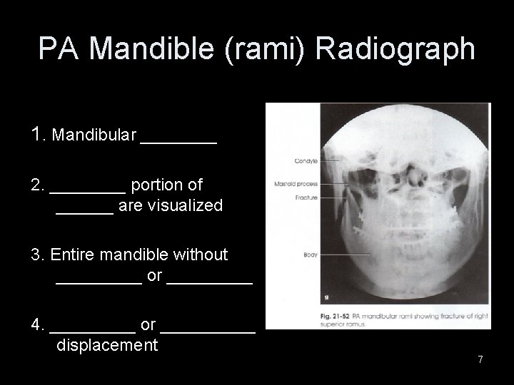 PA Mandible (rami) Radiograph 1. Mandibular ____ 2. ____ portion of ______ are visualized