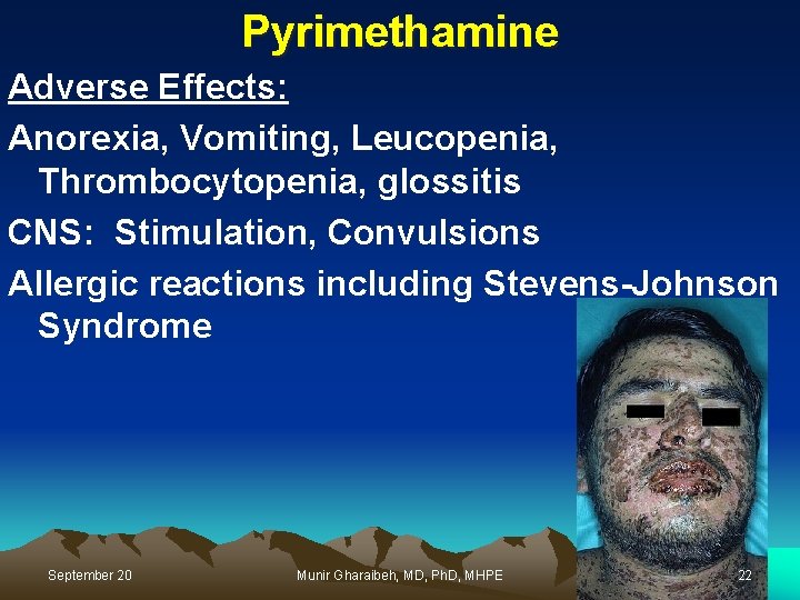 Pyrimethamine Adverse Effects: Anorexia, Vomiting, Leucopenia, Thrombocytopenia, glossitis CNS: Stimulation, Convulsions Allergic reactions including
