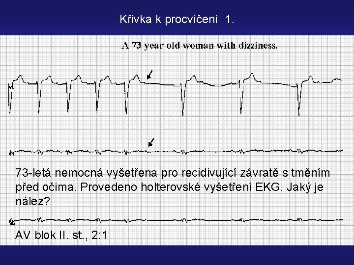 Křivka k procvičení 1. 73 -letá nemocná vyšetřena pro recidivující závratě s tměním před