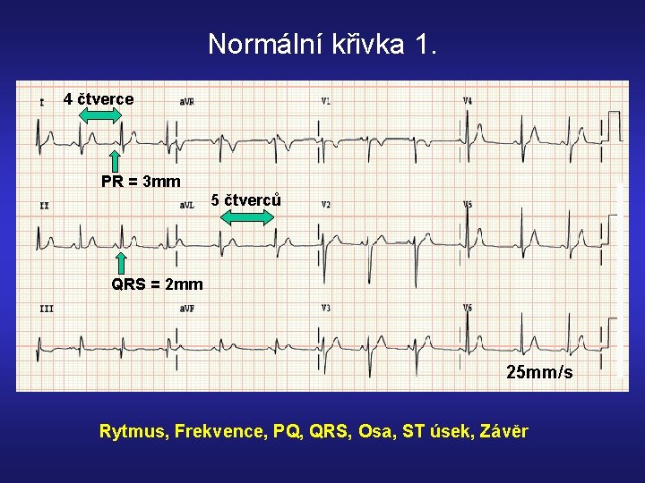 Normální křivka 1. 4 čtverce PR = 3 mm 5 čtverců QRS = 2