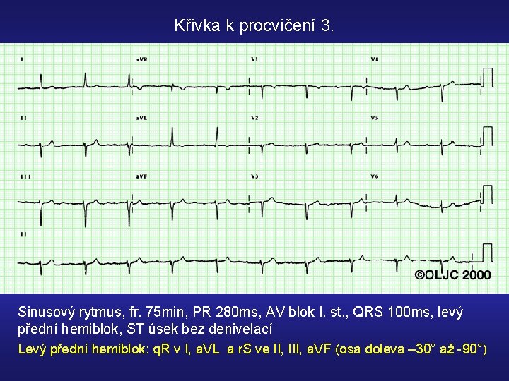 Křivka k procvičení 3. Sinusový rytmus, fr. 75 min, PR 280 ms, AV blok