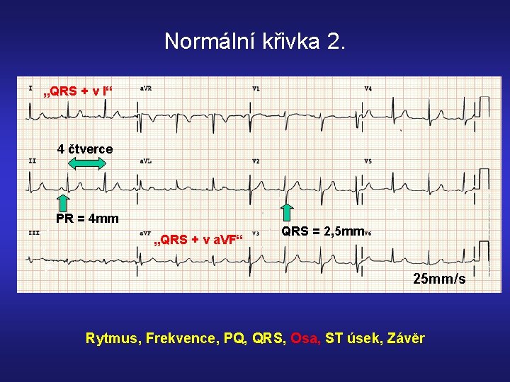 Normální křivka 2. „QRS + v I“ 4 čtverce PR = 4 mm „QRS