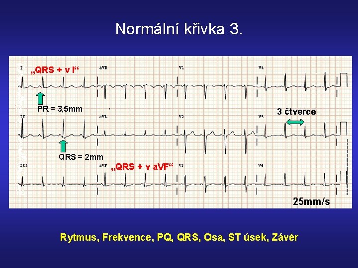 Normální křivka 3. „QRS + v I“ PR = 3, 5 mm 3 čtverce