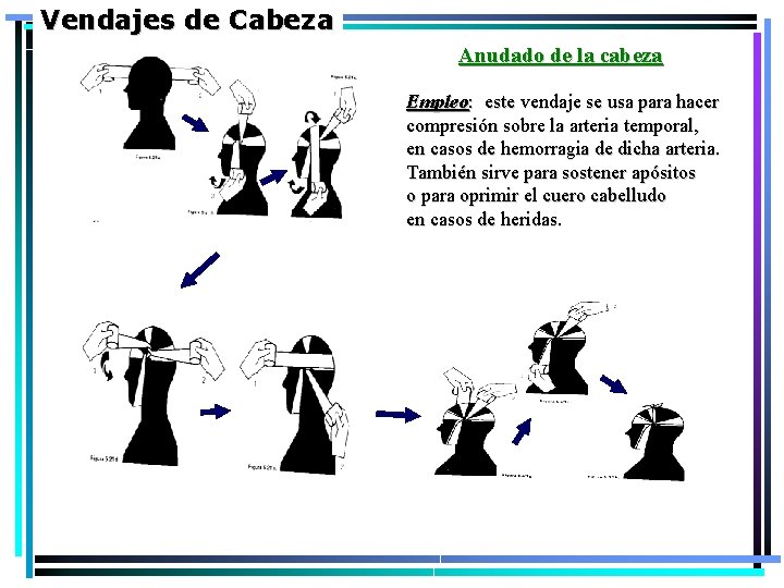 Vendajes de Cabeza Anudado de la cabeza Empleo: este vendaje se usa para hacer Vendajes de Cabeza Anudado de la cabeza Empleo: este vendaje se usa para hacer