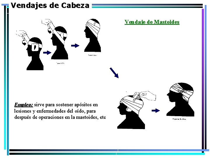 Vendajes de Cabeza Vendaje de Mastoides Empleo: sirve para sostener apósitos en lesiones y Vendajes de Cabeza Vendaje de Mastoides Empleo: sirve para sostener apósitos en lesiones y