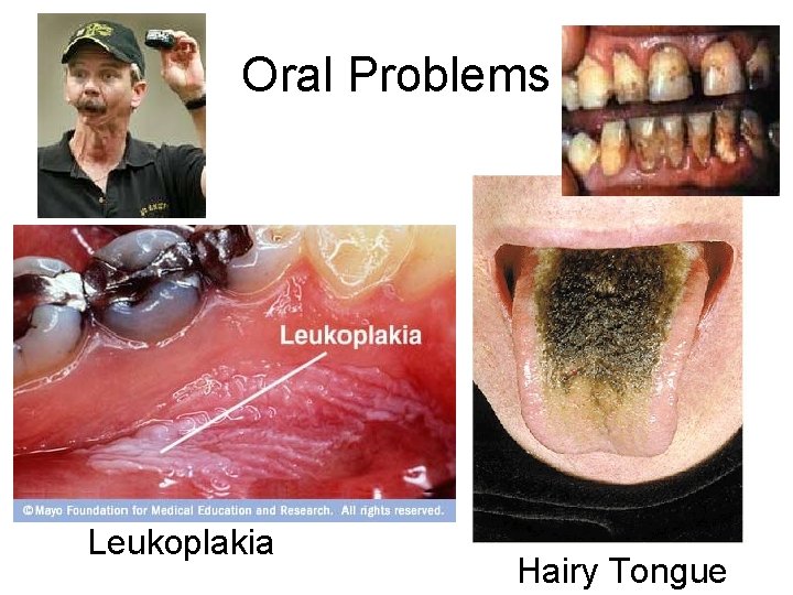 Oral Problems Leukoplakia Hairy Tongue 