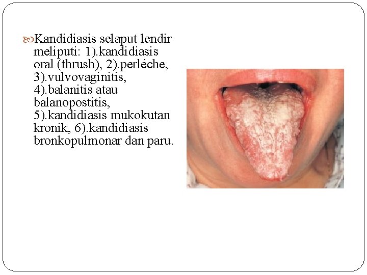  Kandidiasis selaput lendir meliputi: 1). kandidiasis oral (thrush), 2). perléche, 3). vulvovaginitis, 4).