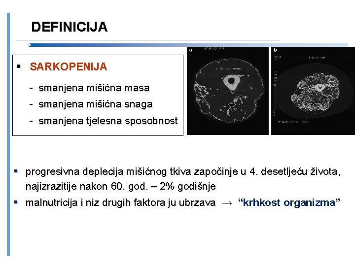 DEFINICIJA SARKOPENIJA - smanjena mišićna masa - smanjena mišićna snaga - smanjena tjelesna sposobnost