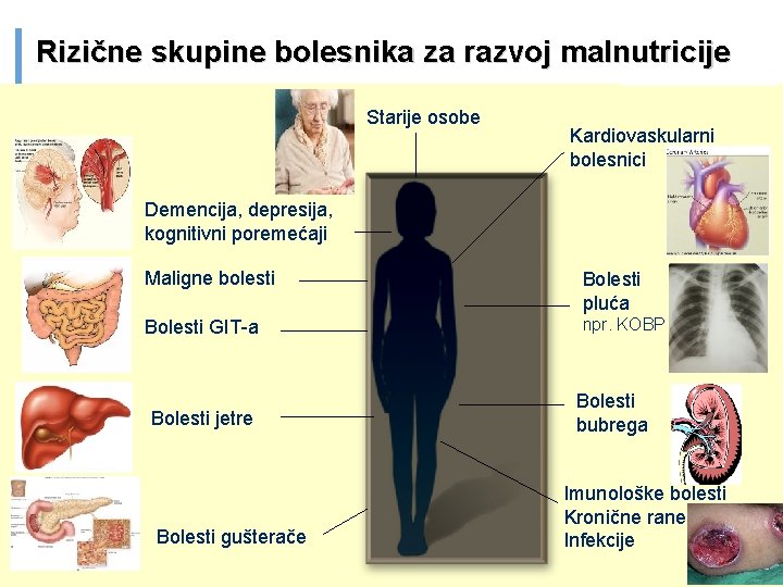 Rizične skupine bolesnika za razvoj malnutricije Starije osobe Kardiovaskularni bolesnici Demencija, depresija, kognitivni poremećaji
