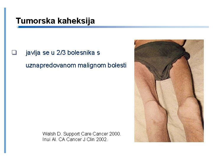 Tumorska kaheksija javlja se u 2/3 bolesnika s uznapredovanom malignom bolesti Walsh D. Support