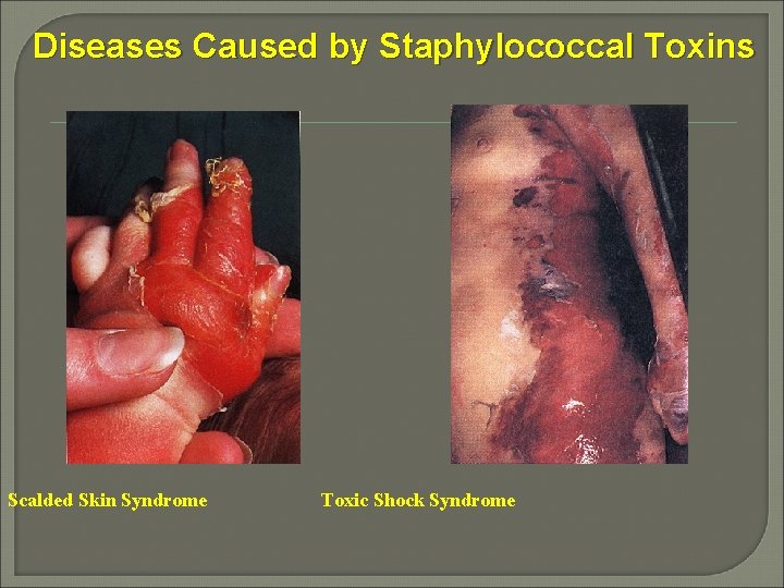 Diseases Caused by Staphylococcal Toxins Scalded Skin Syndrome Toxic Shock Syndrome 
