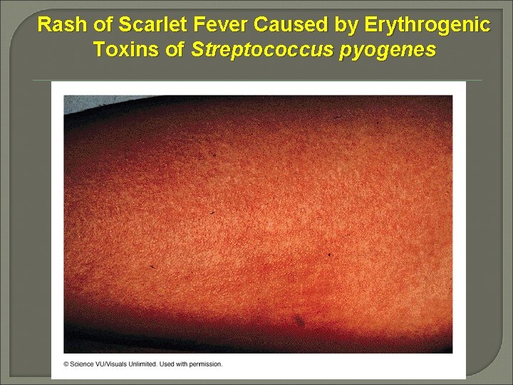 Rash of Scarlet Fever Caused by Erythrogenic Toxins of Streptococcus pyogenes 