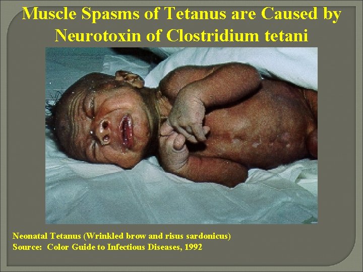 Muscle Spasms of Tetanus are Caused by Neurotoxin of Clostridium tetani Neonatal Tetanus (Wrinkled