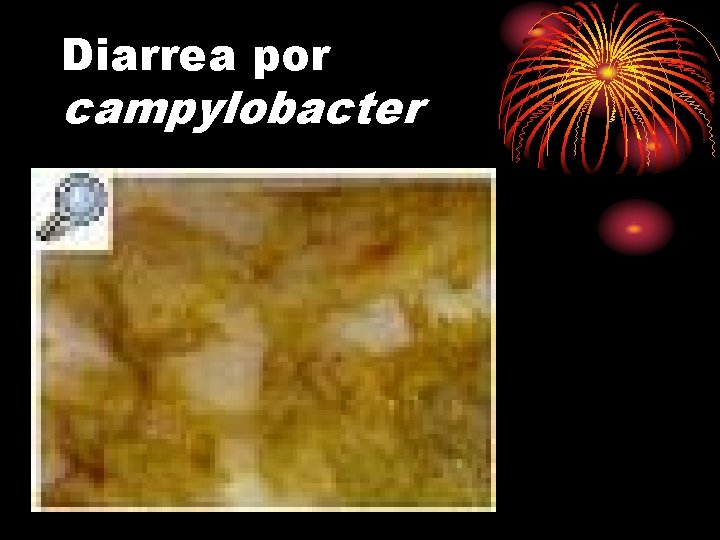 Diarrea por campylobacter 