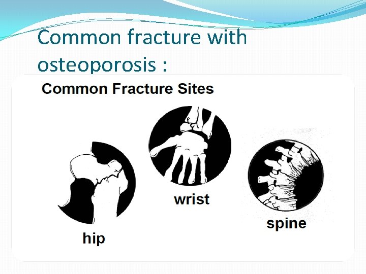 Common fracture with osteoporosis : 