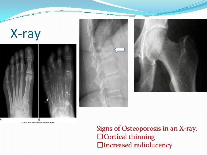 X-ray Signs of Osteoporosis in an X-ray: � Cortical thinning � Increased radiolucency 