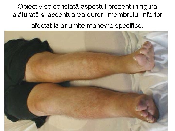 Obiectiv se constată aspectul prezent în figura alăturată şi accentuarea durerii membrului inferior afectat