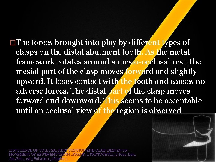 �The forces brought into play by different types of clasps on the distal abutment �The forces brought into play by different types of clasps on the distal abutment