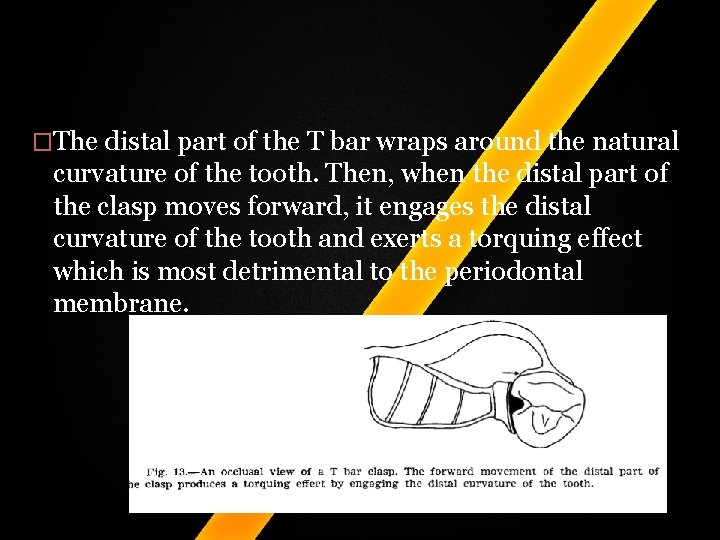 �The distal part of the T bar wraps around the natural curvature of the �The distal part of the T bar wraps around the natural curvature of the