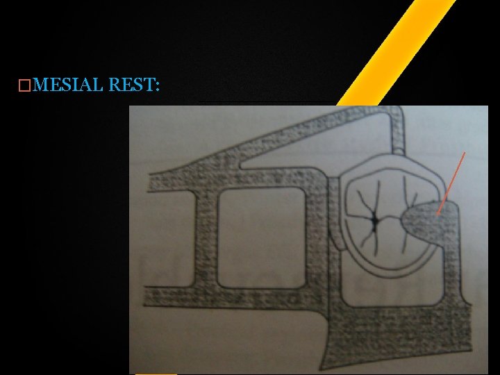 �MESIAL REST: �MESIAL REST: