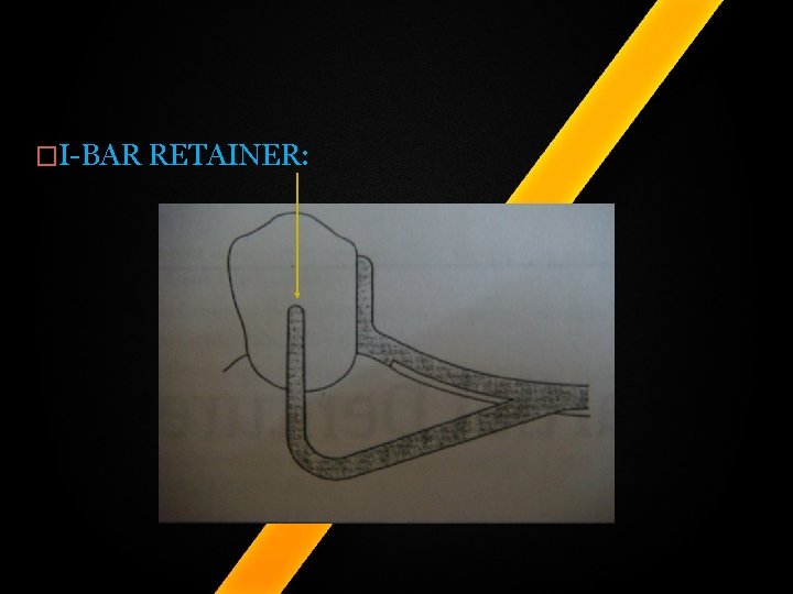 �I-BAR RETAINER: �I-BAR RETAINER: