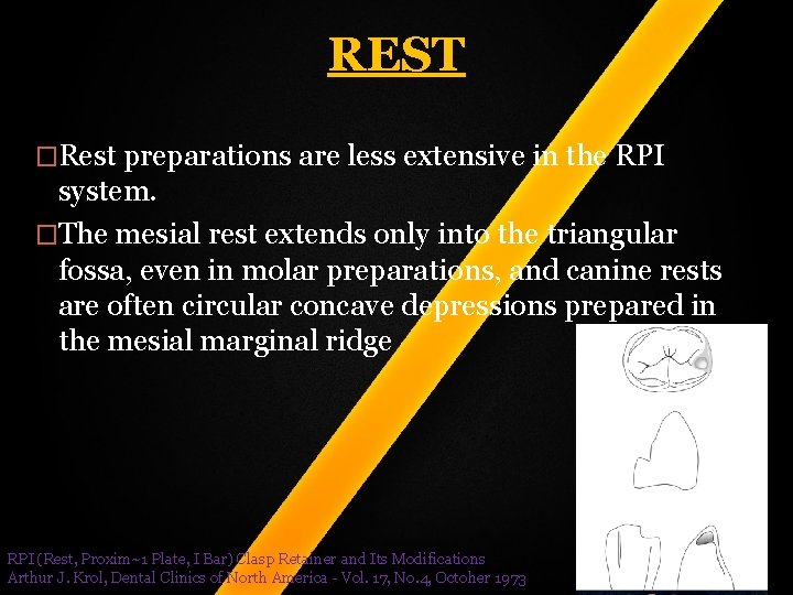 REST �Rest preparations are less extensive in the RPI system. �The mesial rest extends REST �Rest preparations are less extensive in the RPI system. �The mesial rest extends