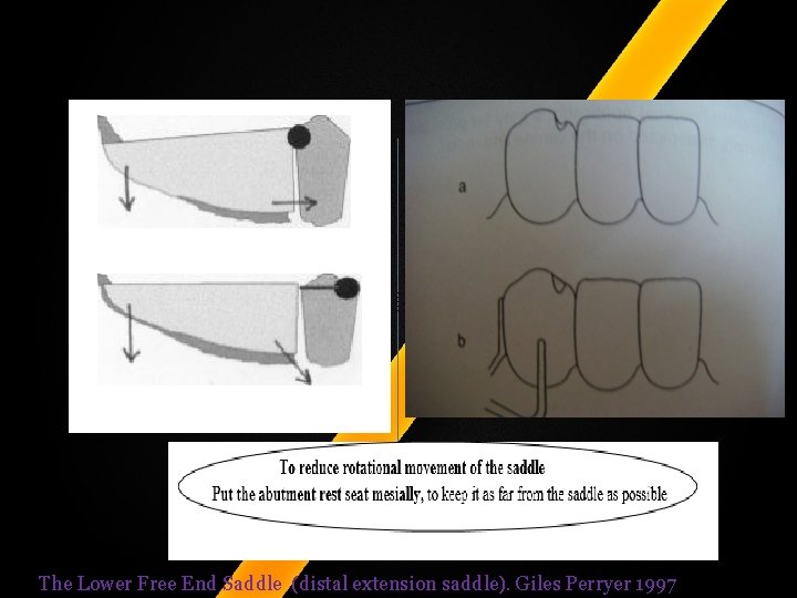 The Lower Free End Saddle (distal extension saddle). Giles Perryer 1997 The Lower Free End Saddle (distal extension saddle). Giles Perryer 1997