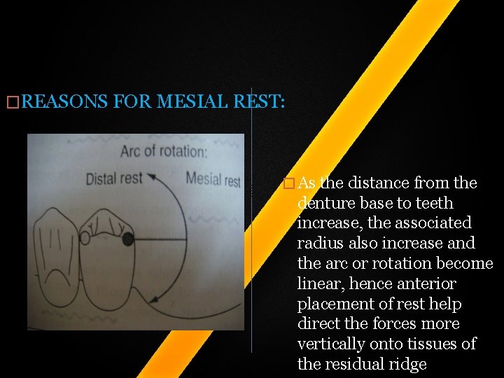 �REASONS FOR MESIAL REST: � As the distance from the denture base to teeth �REASONS FOR MESIAL REST: � As the distance from the denture base to teeth