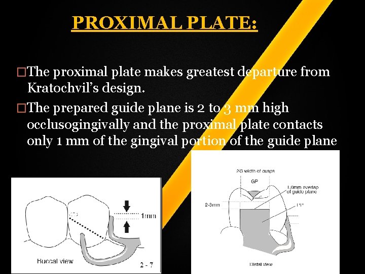 PROXIMAL PLATE: �The proximal plate makes greatest departure from Kratochvil’s design. �The prepared guide PROXIMAL PLATE: �The proximal plate makes greatest departure from Kratochvil’s design. �The prepared guide