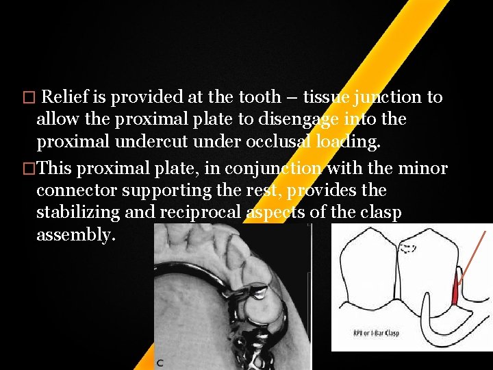 � Relief is provided at the tooth – tissue junction to allow the proximal � Relief is provided at the tooth – tissue junction to allow the proximal