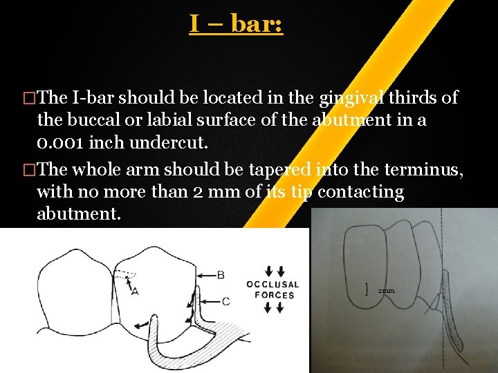 I – bar: �The I-bar should be located in the gingival thirds of the I – bar: �The I-bar should be located in the gingival thirds of the