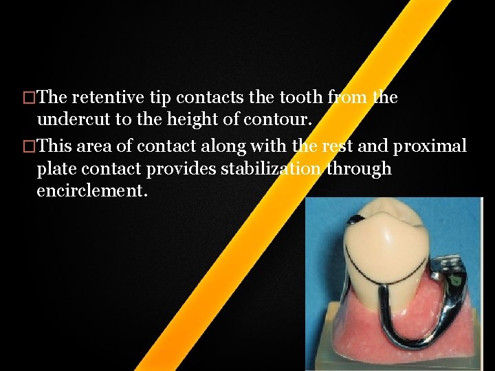 �The retentive tip contacts the tooth from the undercut to the height of contour. �The retentive tip contacts the tooth from the undercut to the height of contour.
