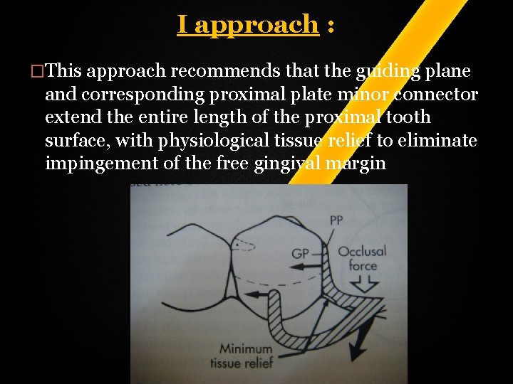 I approach : �This approach recommends that the guiding plane and corresponding proximal plate I approach : �This approach recommends that the guiding plane and corresponding proximal plate