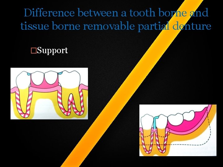 Difference between a tooth borne and tissue borne removable partial denture �Support Difference between a tooth borne and tissue borne removable partial denture �Support