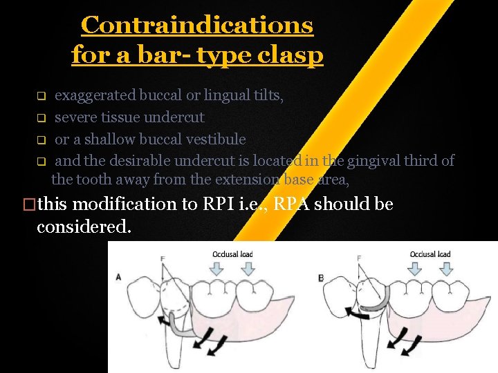 Contraindications for a bar- type clasp q q exaggerated buccal or lingual tilts, severe Contraindications for a bar- type clasp q q exaggerated buccal or lingual tilts, severe
