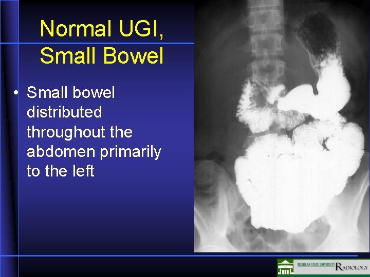 Normal UGI, Small Bowel • Small bowel distributed throughout the abdomen primarily to the