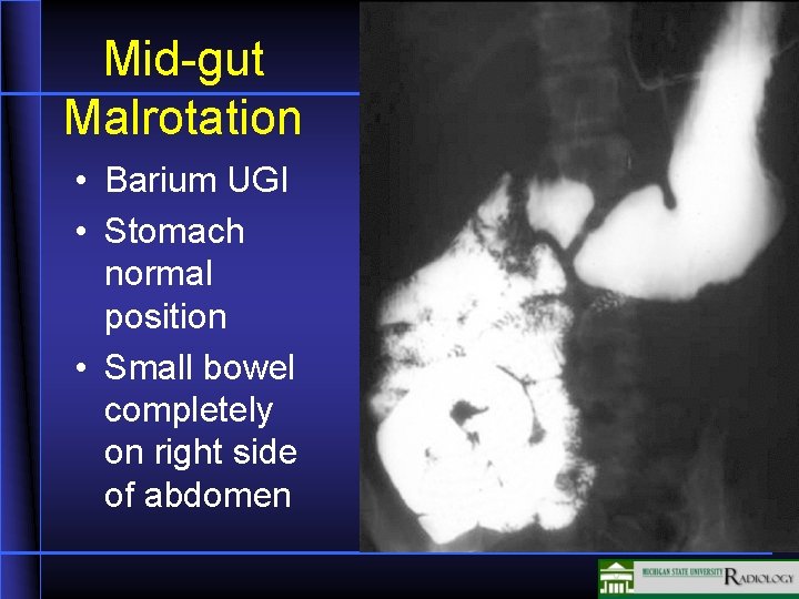 Mid-gut Malrotation • Barium UGI • Stomach normal position • Small bowel completely on