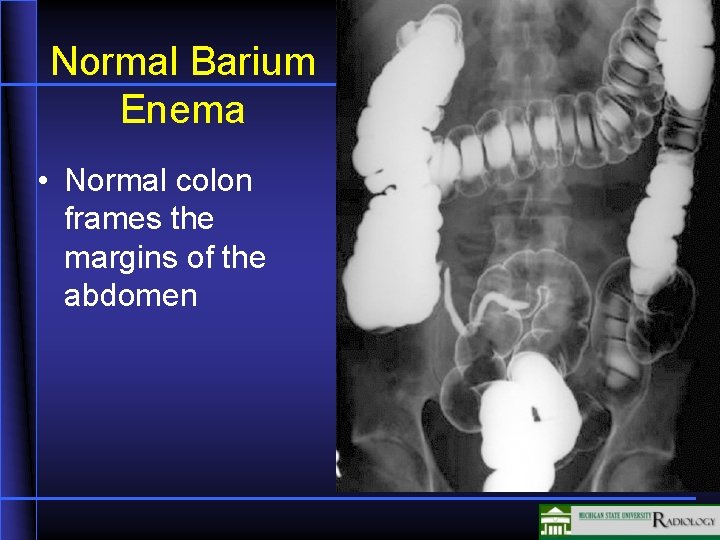 Normal Barium Enema • Normal colon frames the margins of the abdomen Normal Barium Enema • Normal colon frames the margins of the abdomen