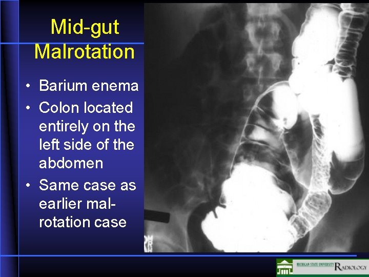 Mid-gut Malrotation • Barium enema • Colon located entirely on the left side of