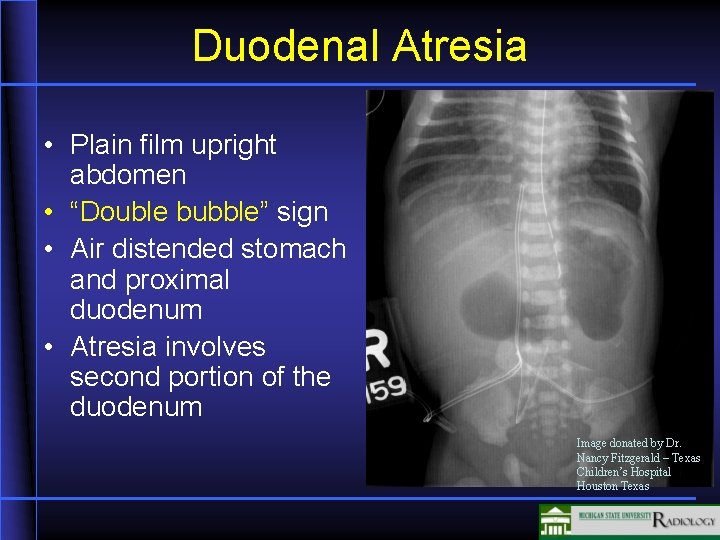 Duodenal Atresia • Plain film upright abdomen • “Double bubble” sign • Air distended Duodenal Atresia • Plain film upright abdomen • “Double bubble” sign • Air distended