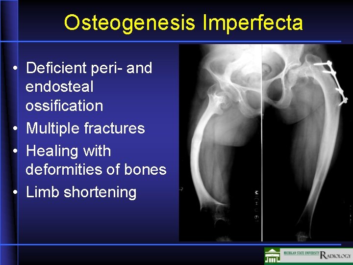 Osteogenesis Imperfecta • Deficient peri- and endosteal ossification • Multiple fractures • Healing with Osteogenesis Imperfecta • Deficient peri- and endosteal ossification • Multiple fractures • Healing with
