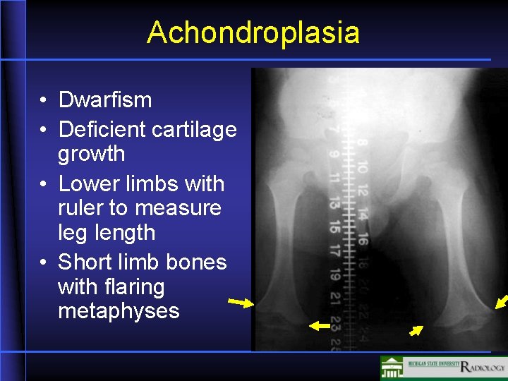 Achondroplasia • Dwarfism • Deficient cartilage growth • Lower limbs with ruler to measure Achondroplasia • Dwarfism • Deficient cartilage growth • Lower limbs with ruler to measure