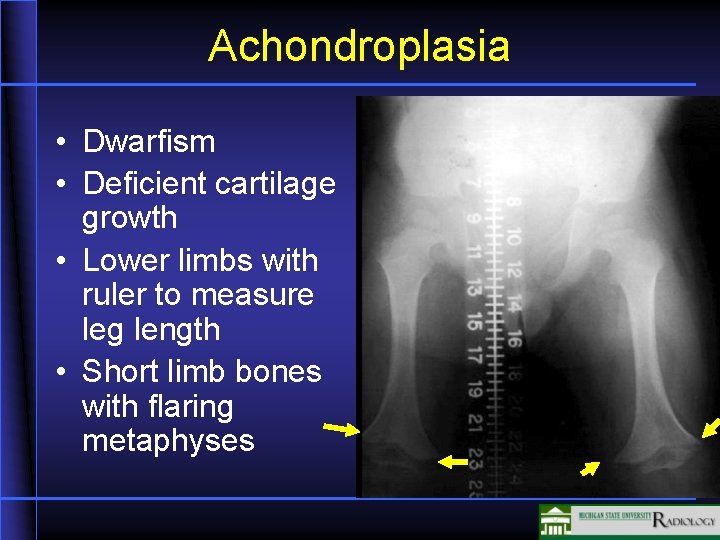 Achondroplasia • Dwarfism • Deficient cartilage growth • Lower limbs with ruler to measure