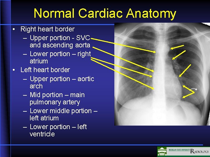 Normal Cardiac Anatomy • Right heart border – Upper portion - SVC and ascending